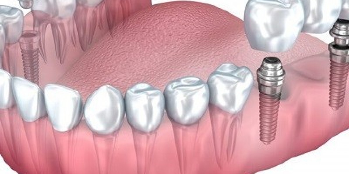 Get a Stronger Bite with Dental Implants
